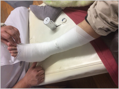下駄骨折 スタッフブログ びっこ治療 歩き方改善 股関節 膝関節